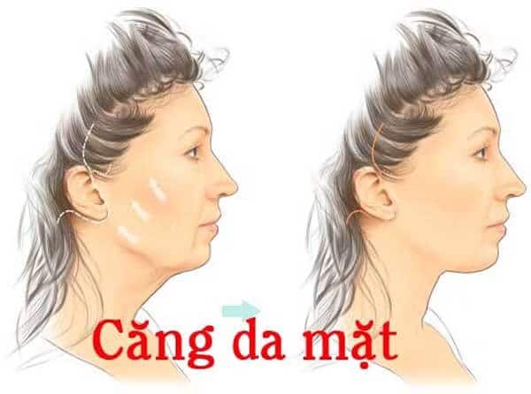 Căng da mặt không phẫu thuật trông tự nhiên hơn 