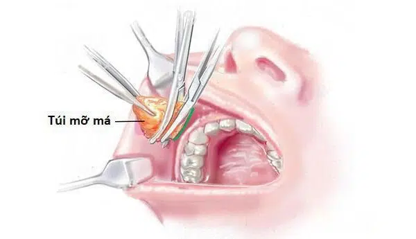 Lấy túi mỡ má