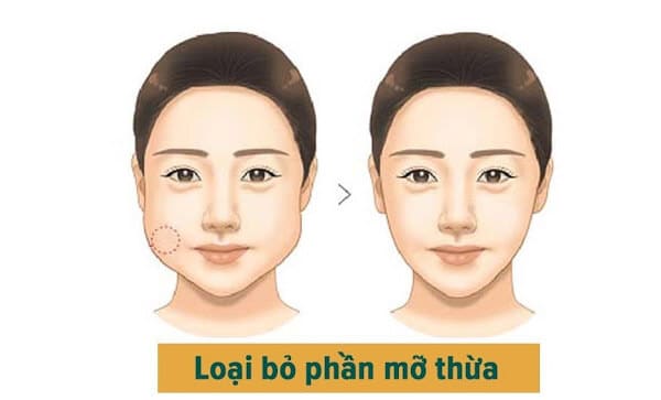 Lấy túi mỡ má cho khuôn mặt tròn