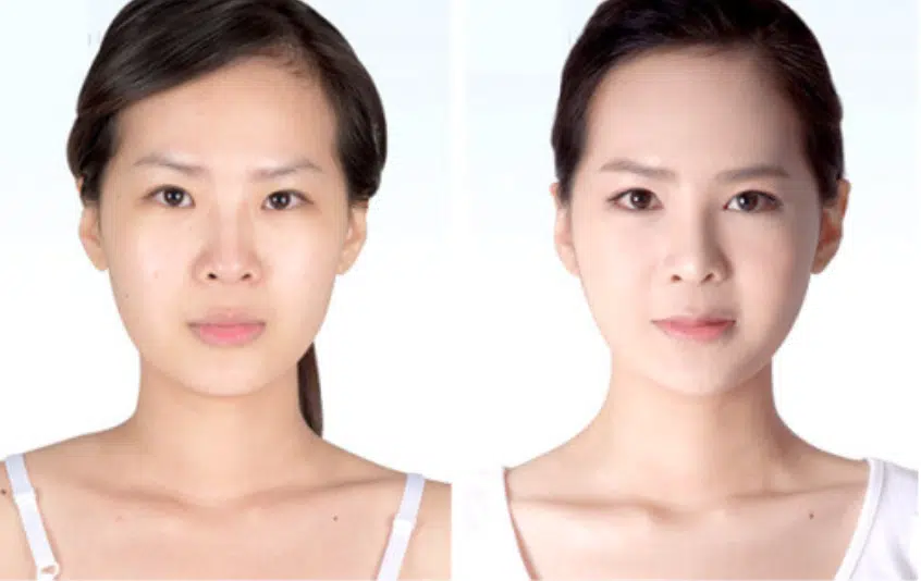 Cấy mỡ tự thân có được vĩnh viễn không? Hình ảnh cấy mỡ tự thân