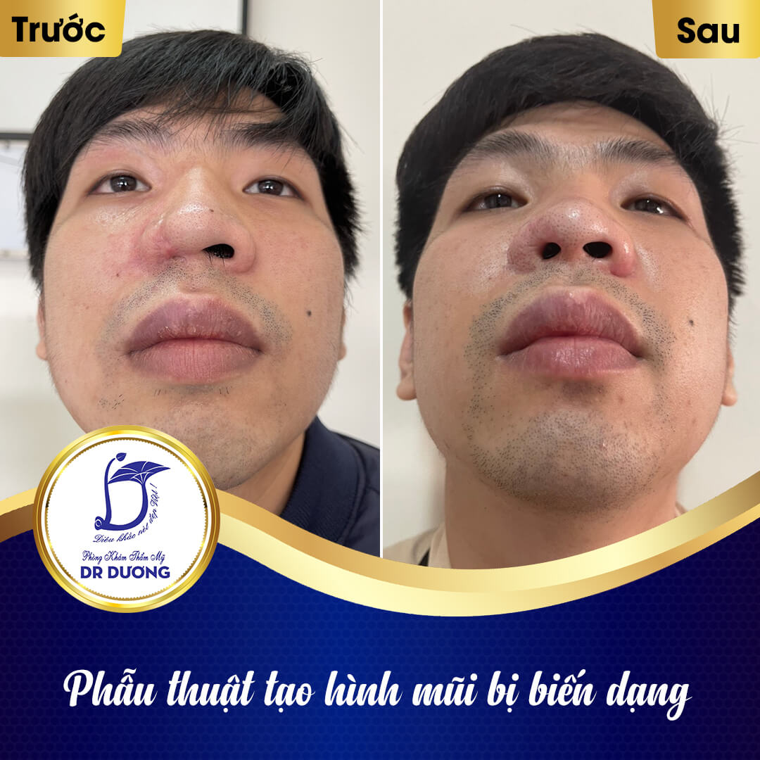 ối tượng khách hàng nào thực hiện phương pháp nâng mũi