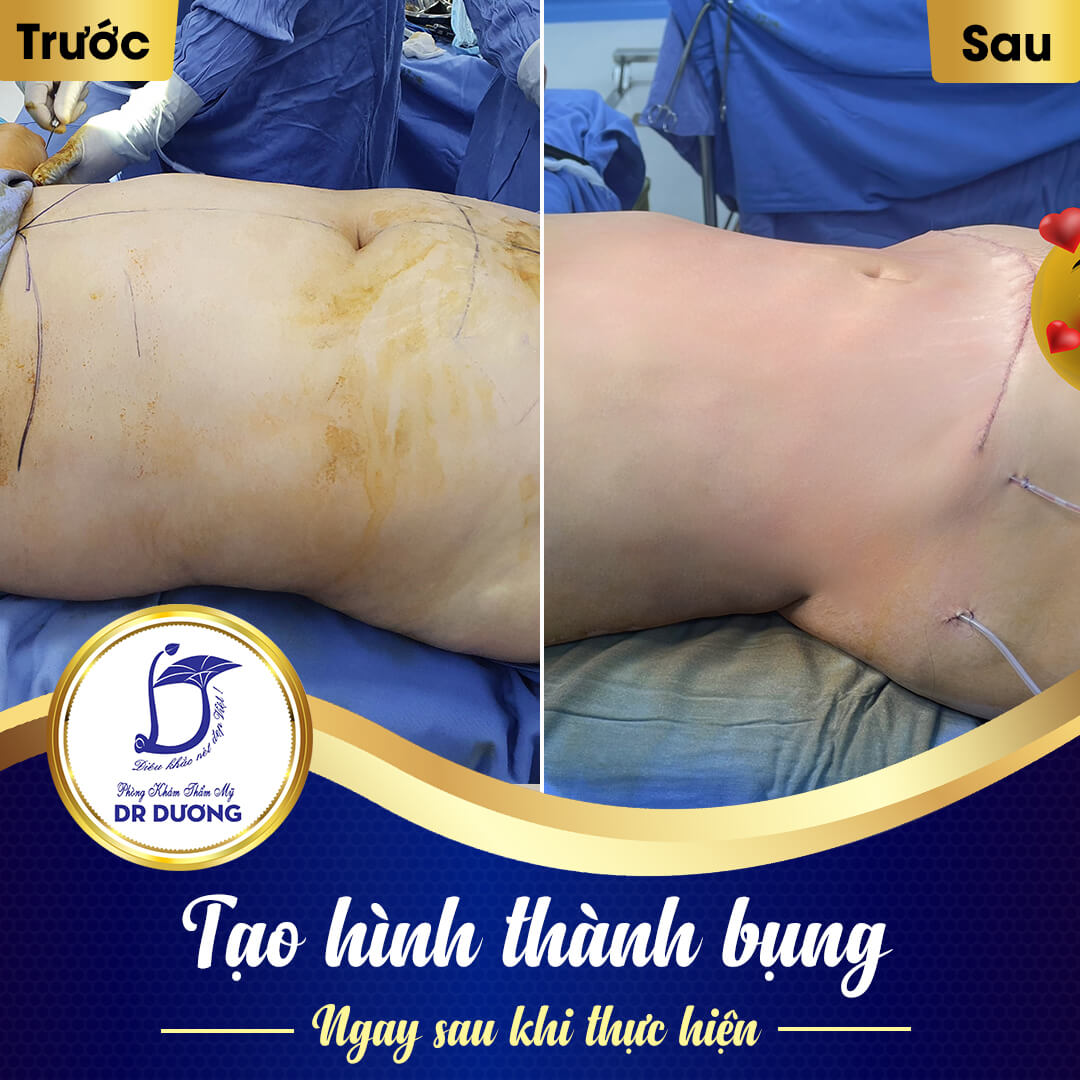 Phẫu thuật tạo hình bụng