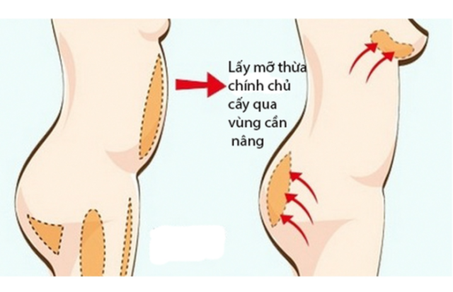 Cấy mỡ tự thân có nguy hiểm không? Rủi ro khi tin lời quảng cáo trên mạng