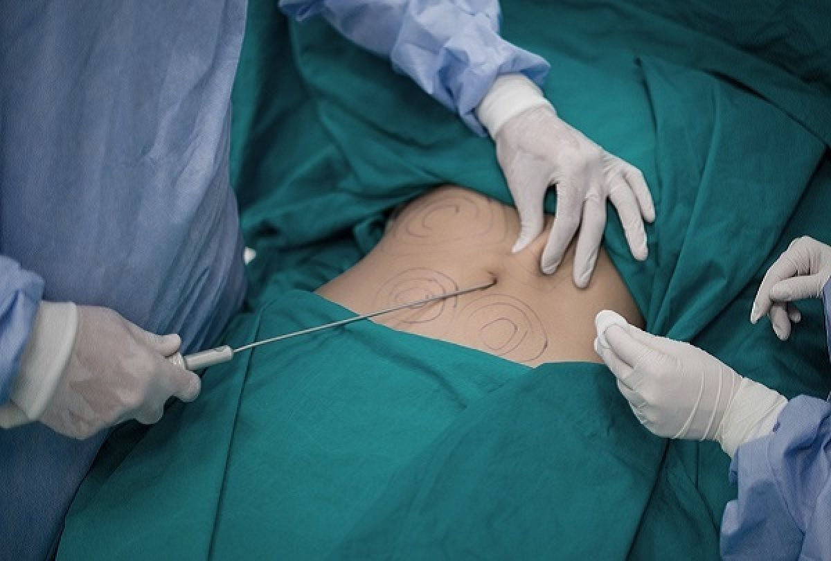 Kỹ thuật Tumescent liposuction