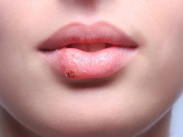Phẫu thuật môi trái tim có để lại sẹo không?