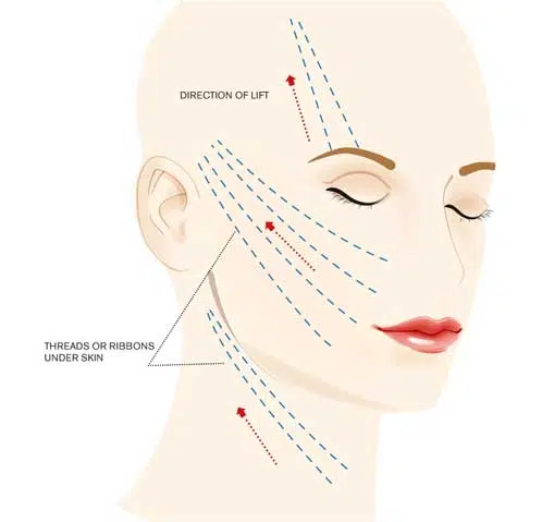 Nhược điểm của căng chỉ collagen
