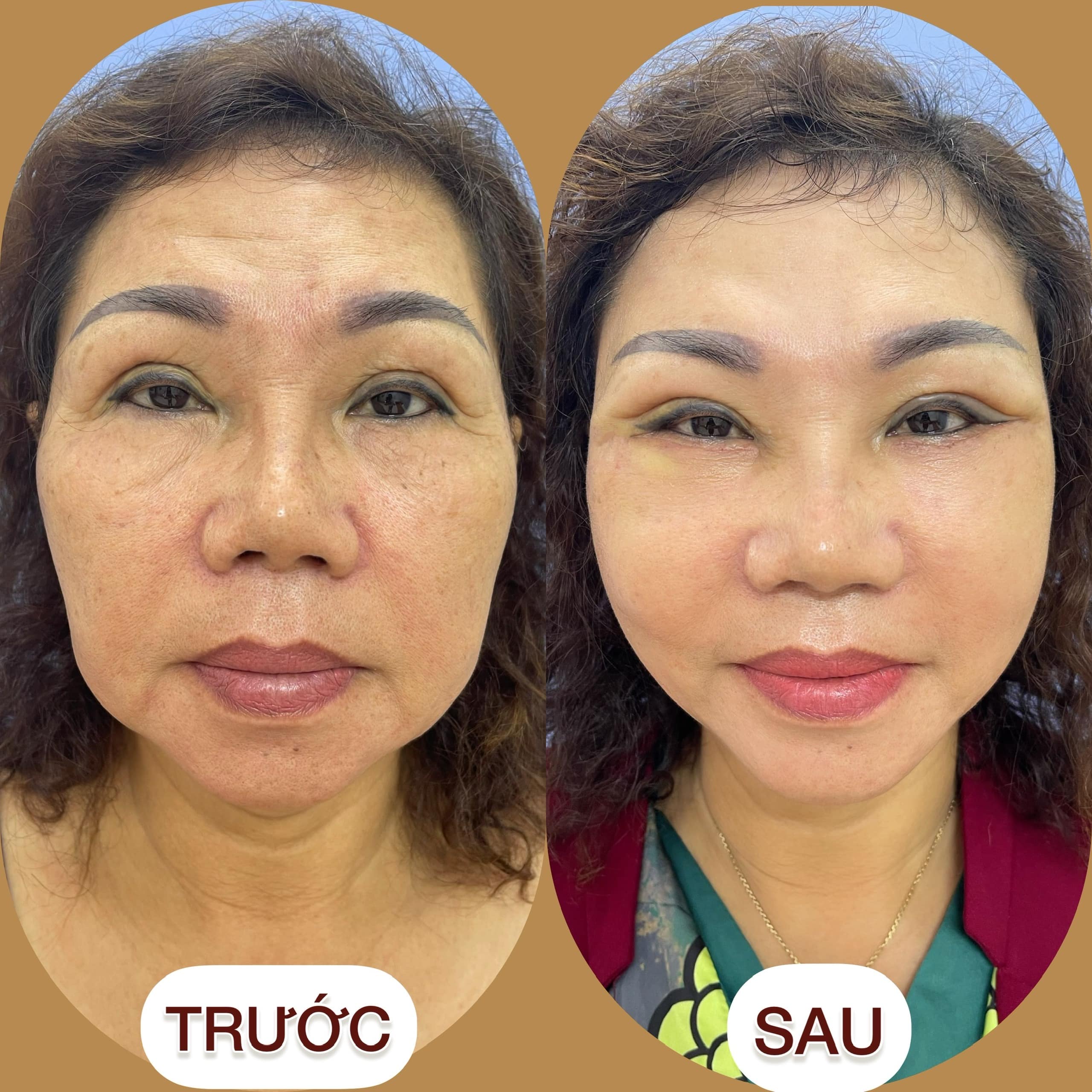 Căng chỉ collagen tại Dr Dương