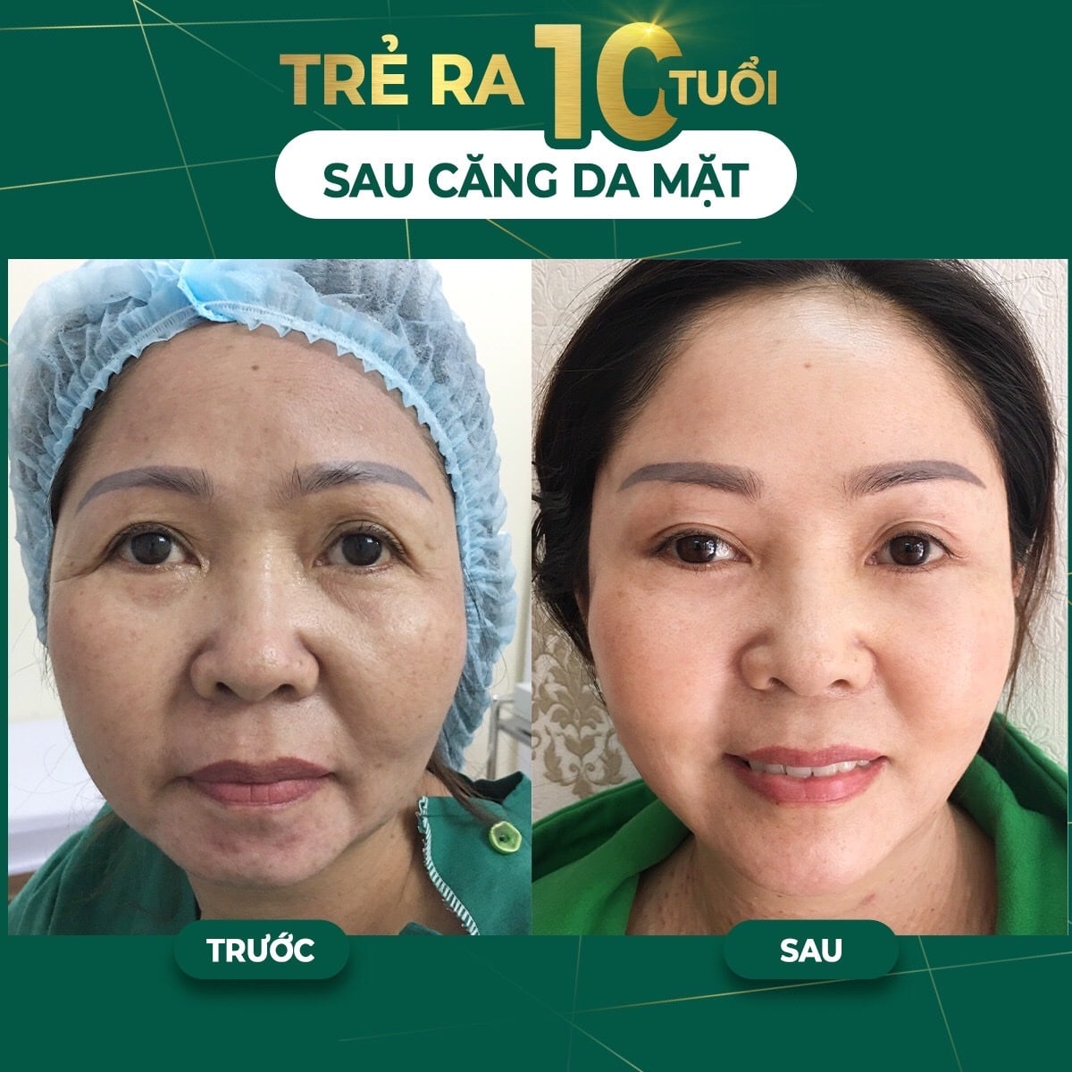 Hình ảnh căng chỉ collagen tại Dr Dương 