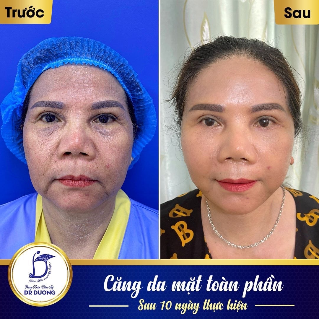 Căng chỉ collagen an toàn tại Thẩm mỹ Dr Dương