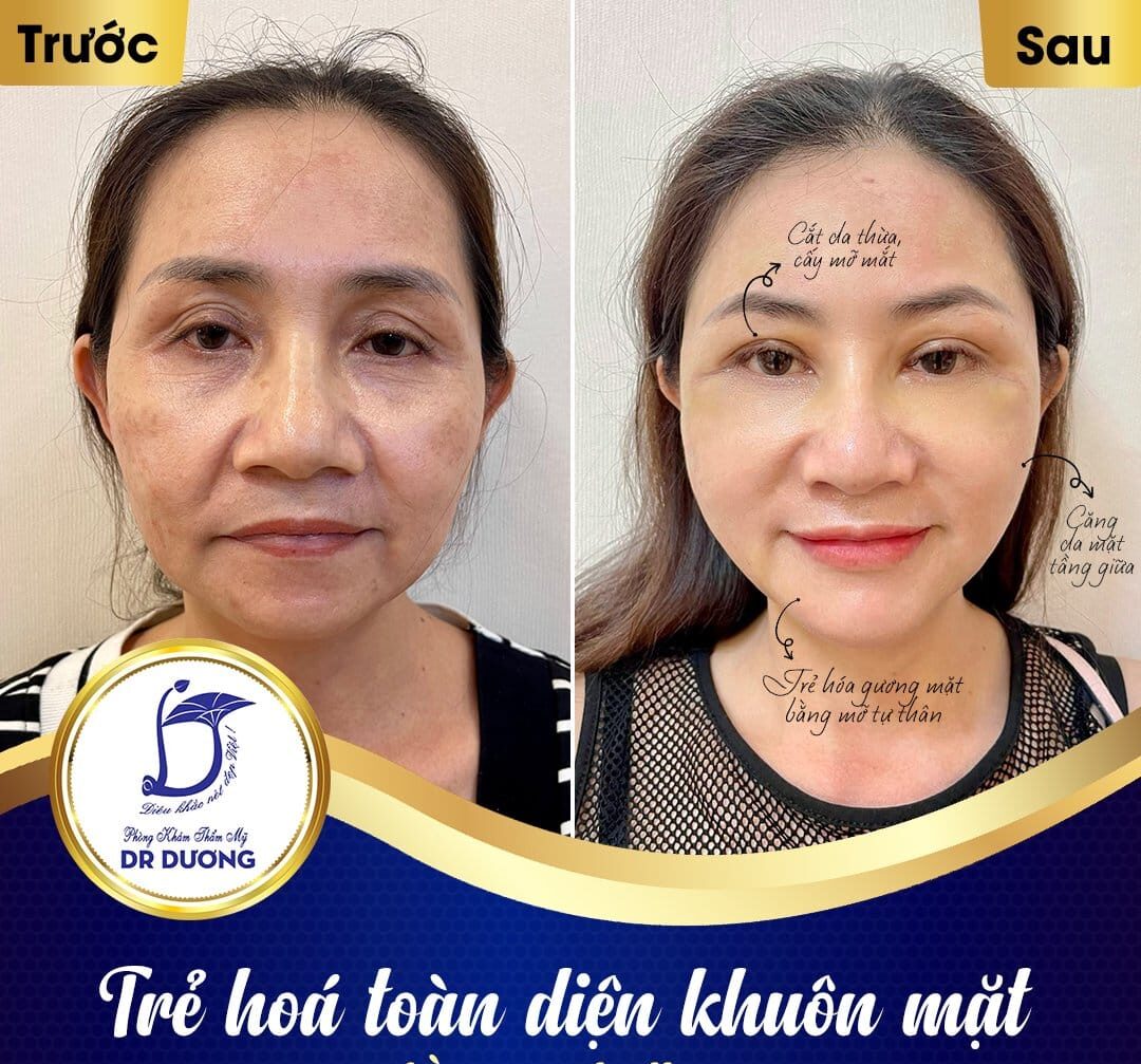 Hình ảnh căng chỉ collagen tại Dr Dương 